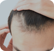 Hair Today, Gone Tomorrow