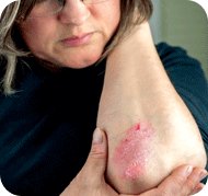 Managing Psoriasis
